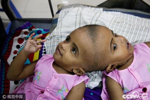 Conjoined twins to undergo surgery to separate their heads