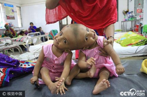 Conjoined twins to undergo surgery to separate their heads